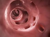 diverticulitus-novosti-erc