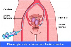 embolizazia-pri-fibrome-matki