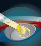 fakoemulsifikazia-erc