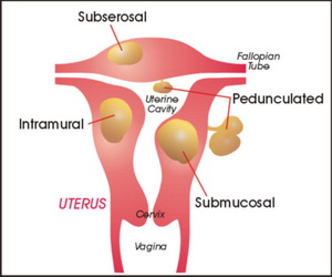 fibroma-matki