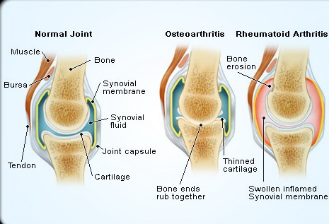 rheumatoid-arthrit 2